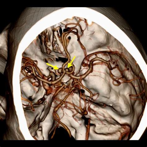 Anterior Communicating Artery Aneurysm Image