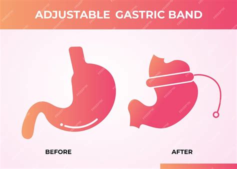 Premium Vector Illustration Of Adjustable Gastric Band Devise Weight