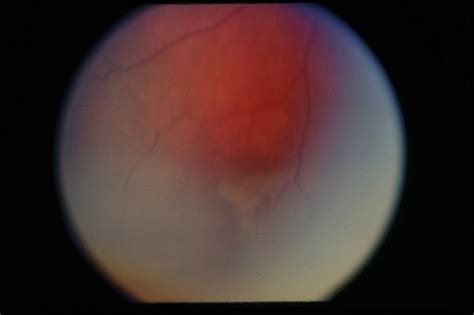 Sturge Weber Choroidal Hemangioma Retina Image Bank