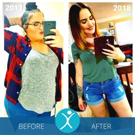 Gastric Sleeve Before and After Photos - The Best Pictures of 2022