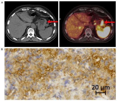 A 68 Ga DOTATOC PET CT Of A Neuroendocrine Carcinoma In The Stomach