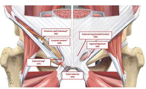 Clinical Examination For Athletes With Inguinal Related Groin Pain