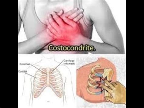 Costocondrite Quais As Causas Tratamentos E Sintomas YouTube