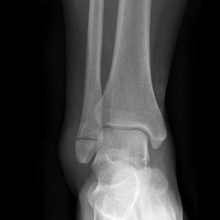 Weber classification of ankle fractures | Radiology Reference Article ...