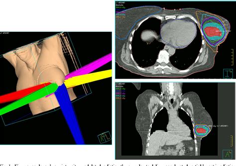 Figure From Accelerated Partial Breast Irradiation Is Safe And