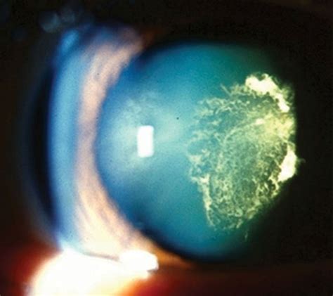 Shared Decision Making Shows Promise In Glaucoma Cataract Care