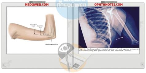 Management of Missed Implanon - Meduweb