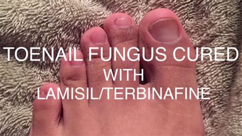 Toenail Fungus Beforeafter Lamisilterbinafine 2019 Youtube