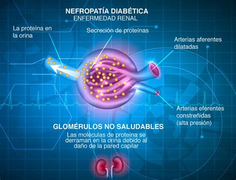 Fisiopatología De La Neuropatía Diabética