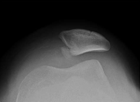 Patella Avulsion Fracture