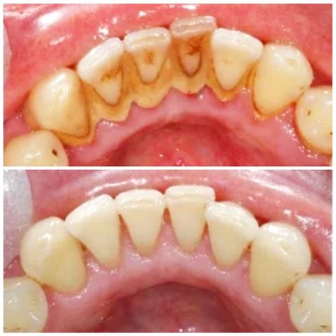 Dental Calculus Before And After