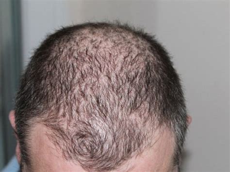 Alopecia Areata: New Symptoms, Causes, And Treatment - Health - Nigeria