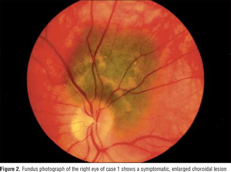 Figure 1 From Histopathology Of Documented Growth In Small Melanocytic