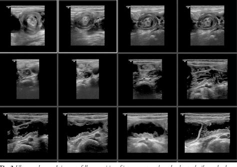 Figure 3 From Ultrasound Guided Reduction Of Ileocolic Intussusception