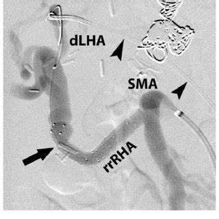 Superior mesenteric artery (SMA) arteriogram in the right oblique... | Download Scientific Diagram