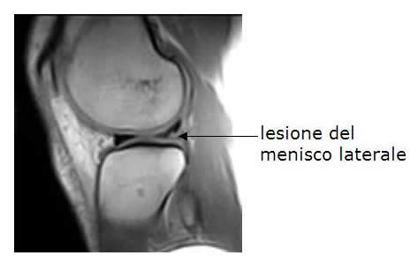 Le Malattie Sorprese Lesioni Meniscali Ginocchio Rmn Lesione Menisco