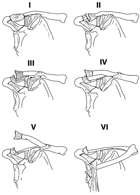 Jcm Free Full Text Acromioclavicular Joint Lesions In Adolescentsa