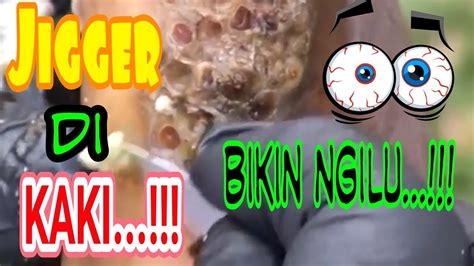 Jigger Larva Lalat Yg Bersarang Di Kaki Youtube