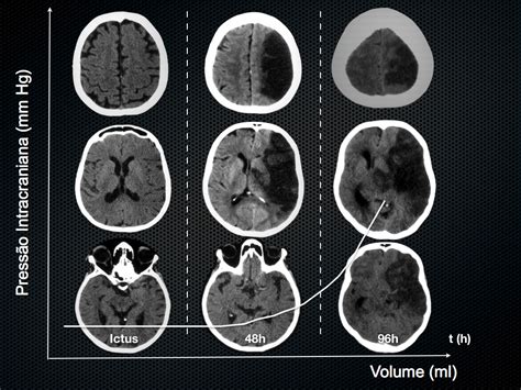 Neurointensivismo Evento Vascular Encef Lico Isqu Mico Maligno