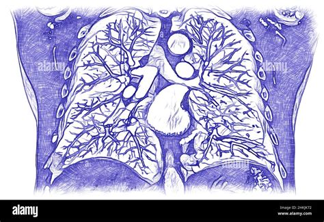 Healthy lungs, CT scan Stock Photo - Alamy