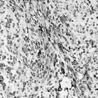 Immunohistochemical Analysis Of Glut Intensity Of Glut Staining