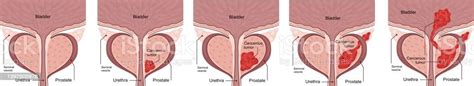 Medical Diagram Of 4 Stages Of Prostate Cancer Tumor Grows And