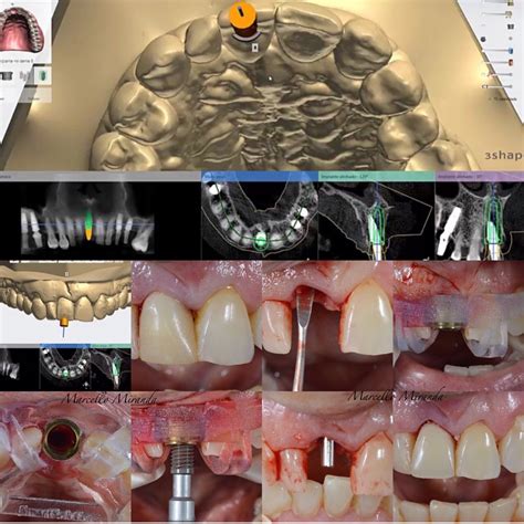 Implante dentário Copacabana Miranda Odontologia Cirurgia guiada