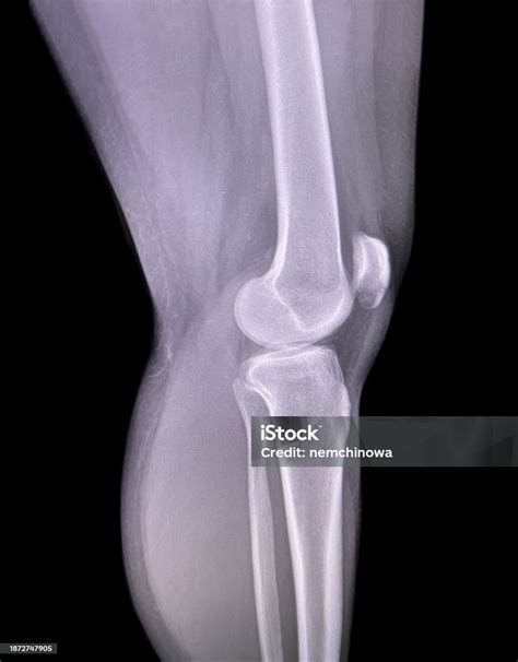 Xray Of Knee Joint Side View Stock Photo - Download Image Now - Anatomy ...