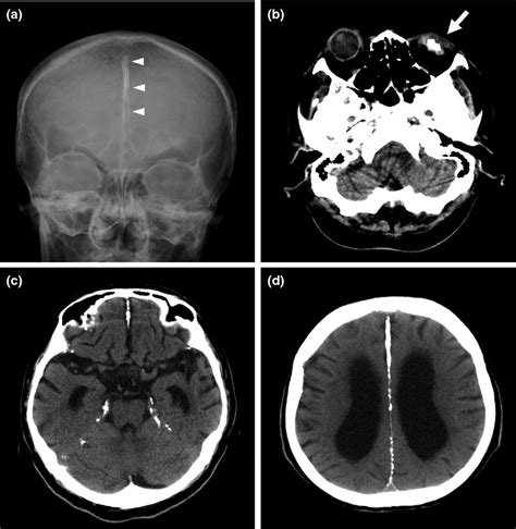 Falx Cerebri Calcification And Microphthalmia In Gorlin Syndrome