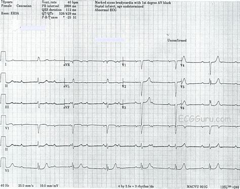 Junctional escape rhythm | ECG Guru - Instructor Resources