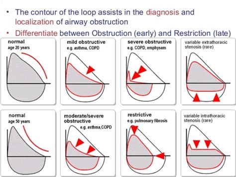 Spirometry Obstructive Pattern