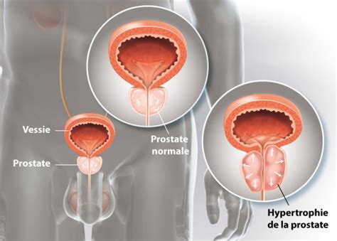 Ad Nome De La Prostate L Examen Urologique