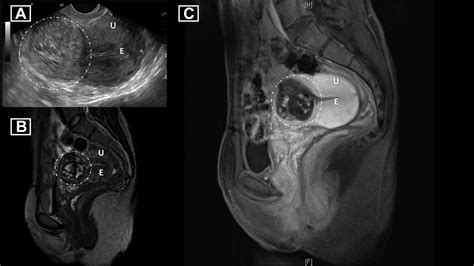 Conservative Management Of Cesarean Scar Pregnancy Following Diagnosis