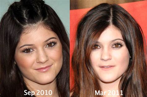 Kylie Jenner Plastic Surgery Before and After Eyebrows