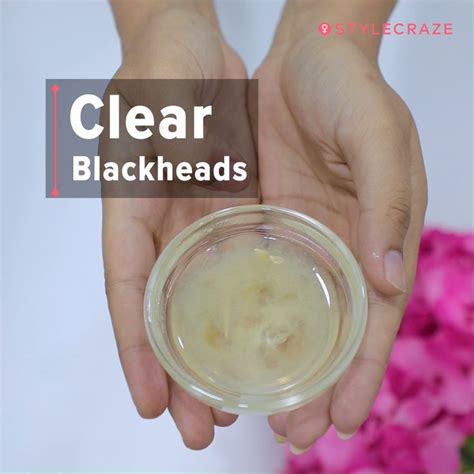 13 proven ways to get rid of blackheads and prevention tips – Artofit