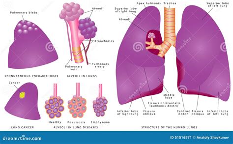 Pneumothorax Diagram Stock Illustrations – 103 Pneumothorax Diagram Stock Illustrations, Vectors ...