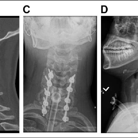 A Preoperative Sagittal Computed Tomography Ct Scan B