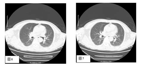 做 Ct 时憋没憋气能看出来吗？ 丁香园