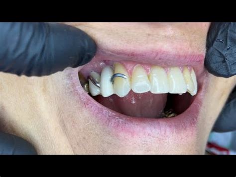 PRÓTESIS DENTALES Adiós a los ganchos metálicos YouTube