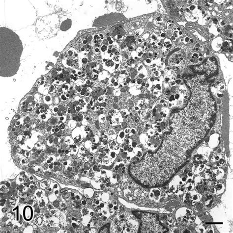 Granular Cell Tumor Electron Microscopy