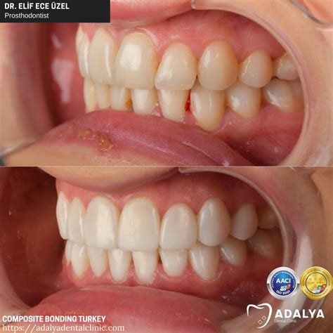 Dentistry Turkey Cosmetic Dentistry Antalya Adalya Dental Clinic