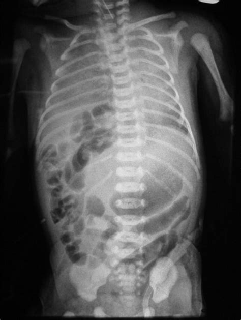 Right Sided Congenital Diaphragmatic Hernia Masqueraded As Right Lobar