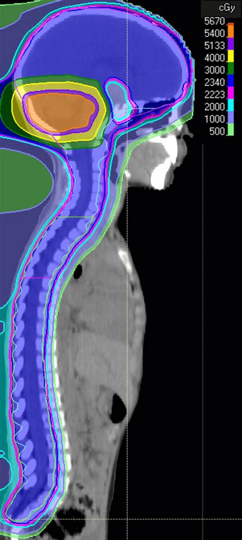 Sagittal View Of The Intensity Modulated Proton Therapy Impt Download Scientific Diagram