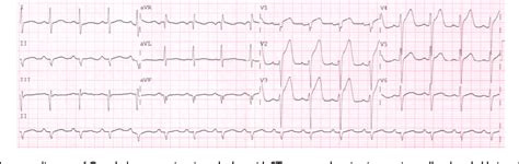 Figure From Isolated Right Ventricle Acute Myocardial Infarction