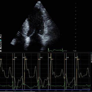 Systolic anterior motion (SAM) of the mitral valve visualized by M-Mode ...