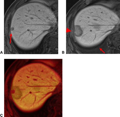 A 64 Year Old Male With A 10 Mm Subcapsular HCC At S8 Of The Liver A