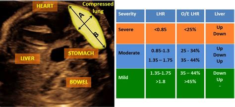 Congenital Diaphragmatic Hernia Cdh Treatment Johns Hopkins Center For Fetal Therapy