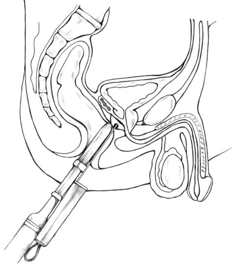 Transrectal Prostate Biopsy With An Ultrasound Probe Guiding The Needle To The Prostate Media