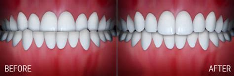 Before And After Gibson Orthodontics Henderson Nevada