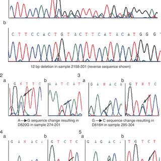 Chromatograms showing sequence variants in KIT gene sequence in ... 